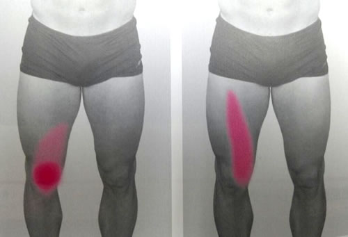 大川接骨院（金沢）　膝の関節の痛みから波及する痛みの分布図
