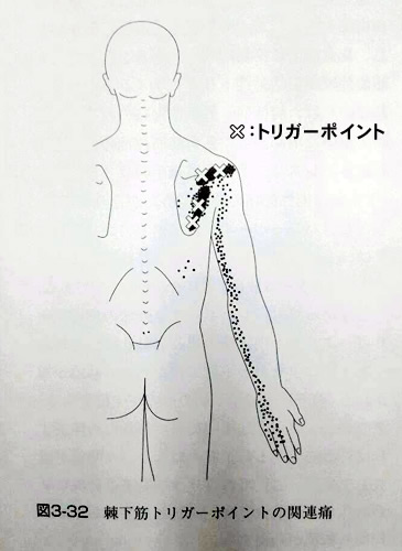 棘下筋のトリガーポイントによる肩から腕、指先まで放散する疼痛パターンの図　大川接骨院（金沢）