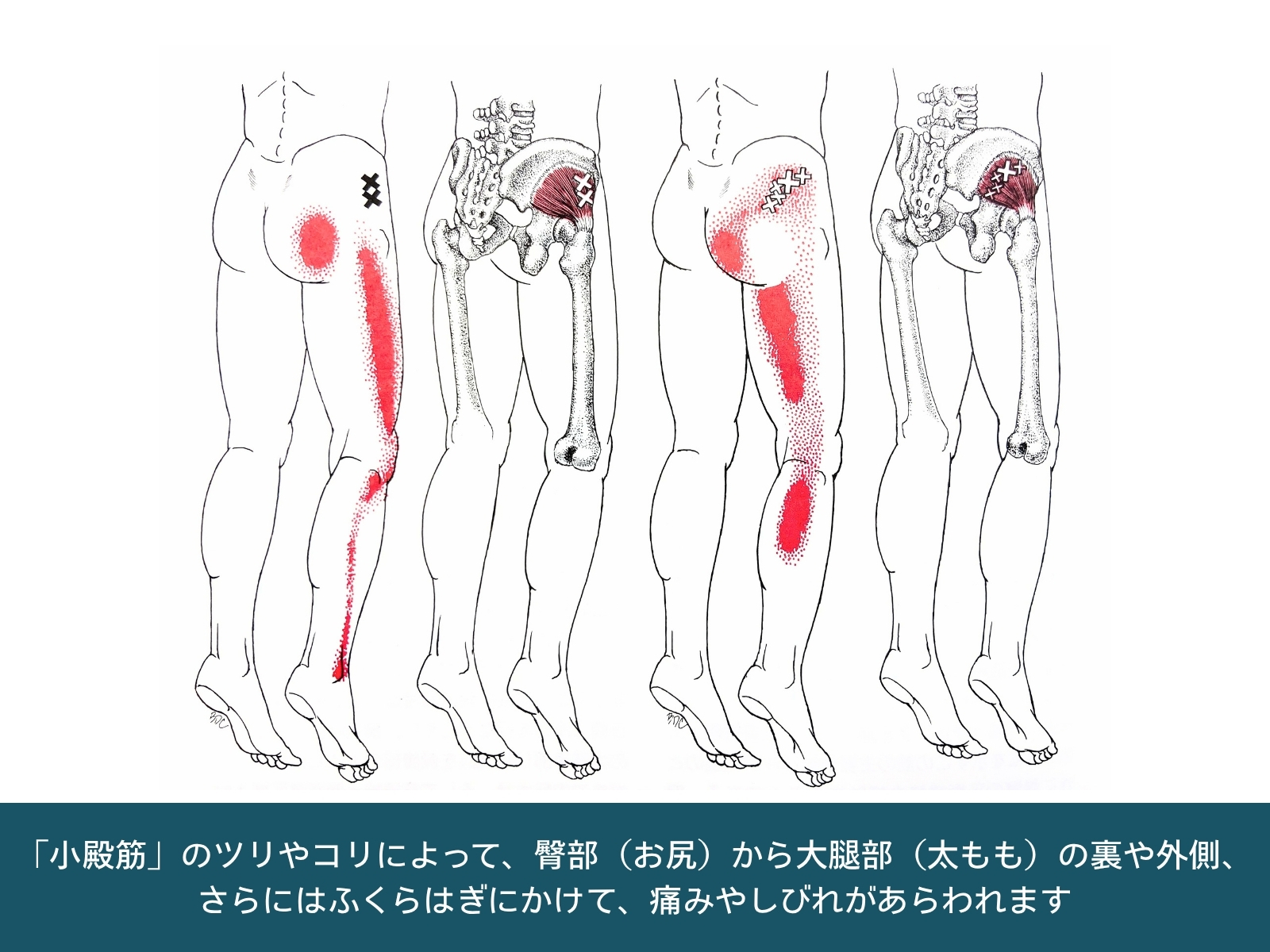 小殿筋のコリやトリガーポイントによってお尻から太もも・ふくらはぎへ生じる痛みとしびれの放散領域を示す図解。